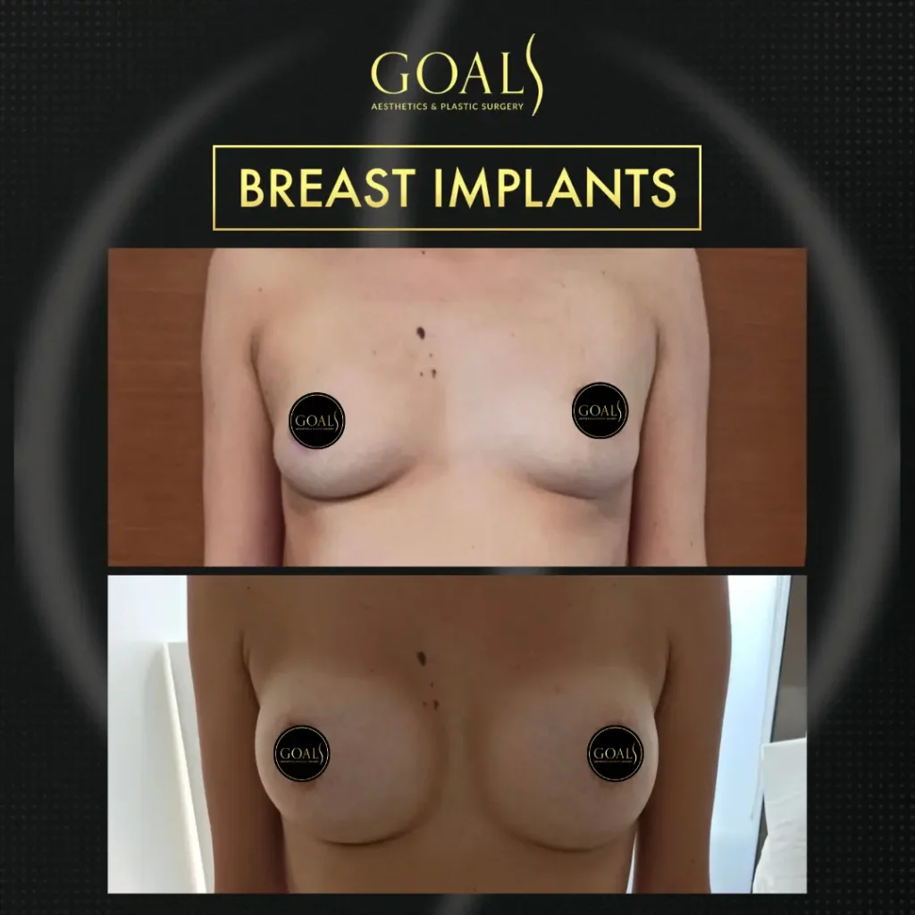 Before and after — Breast Augmentation, patient 3