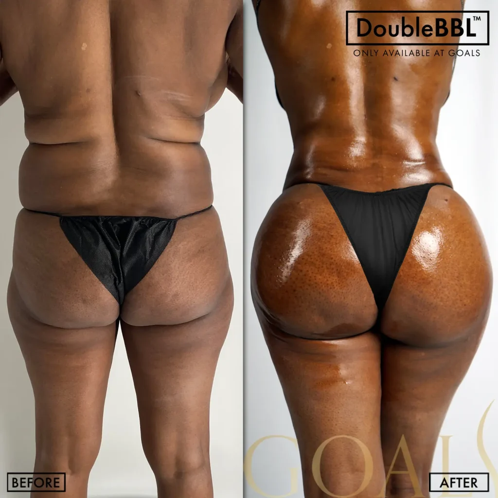 Before and after — Brooklyn, patient 1