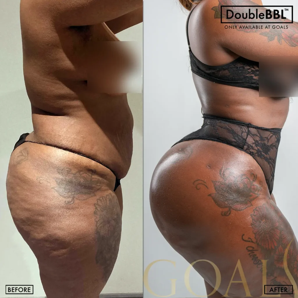 Before and after — Central Park, patient 4