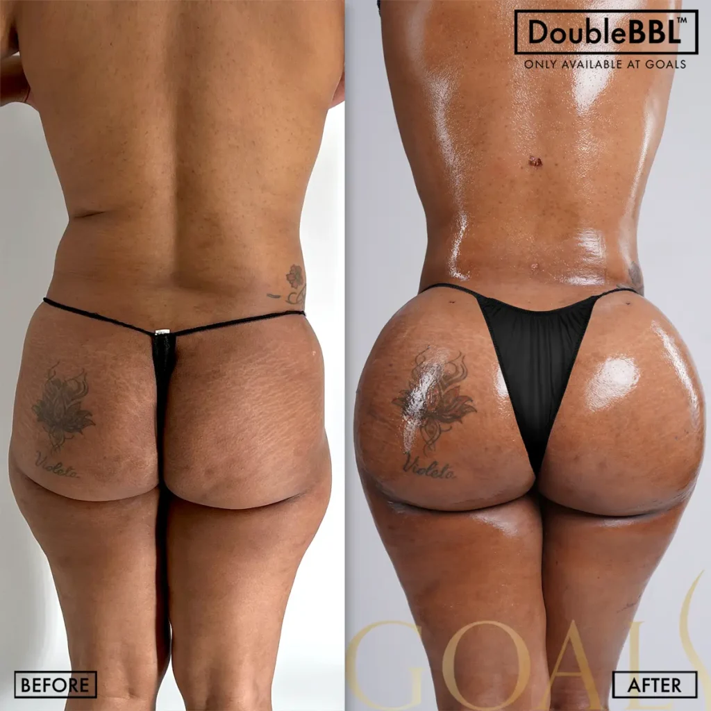 Before and after — Bronx, patient 6