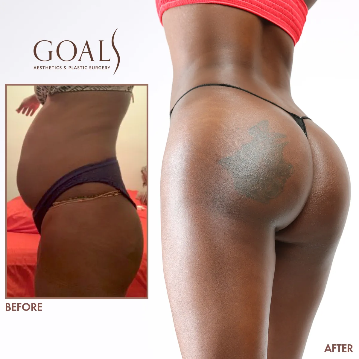 Before and after — Brazilian Butt Lift, patient 1