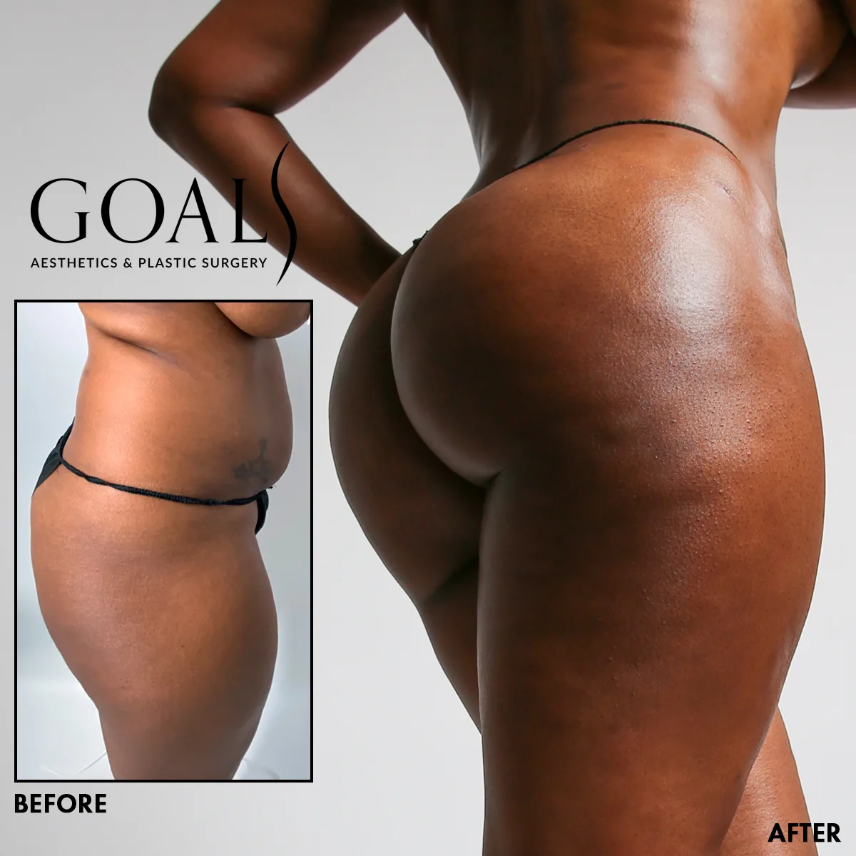 Before and after — Brazilian Butt Lift, patient 4