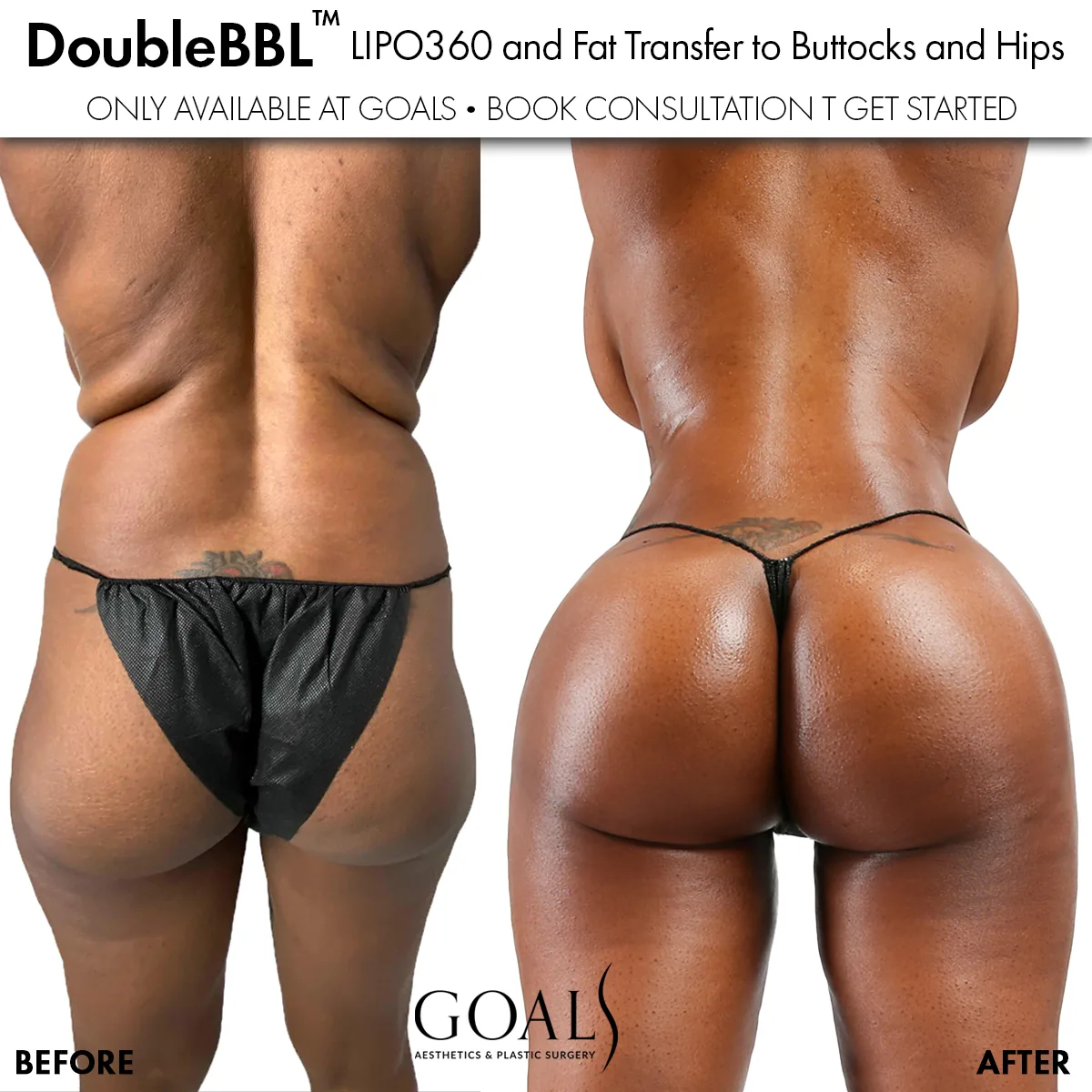 Before and after — Brazilian Butt Lift, patient 5