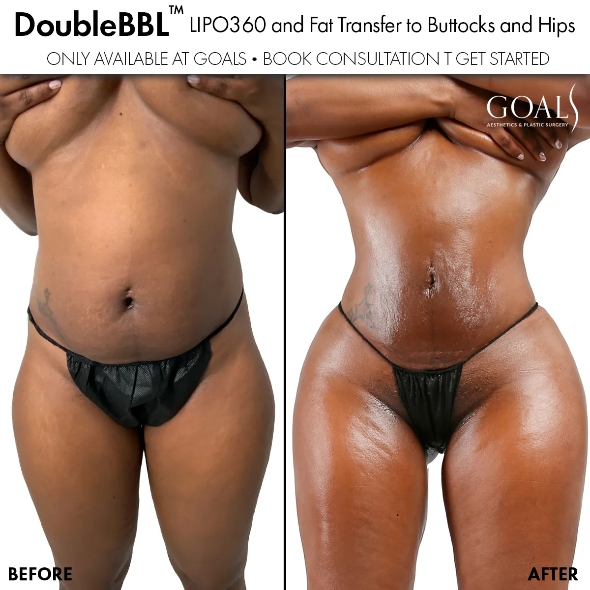 Before and after — Brazilian Butt Lift, patient 6