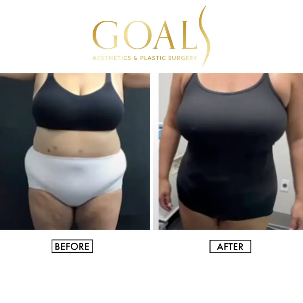 Before and after — Awake Liposuction with FlexSculpt, patient 1