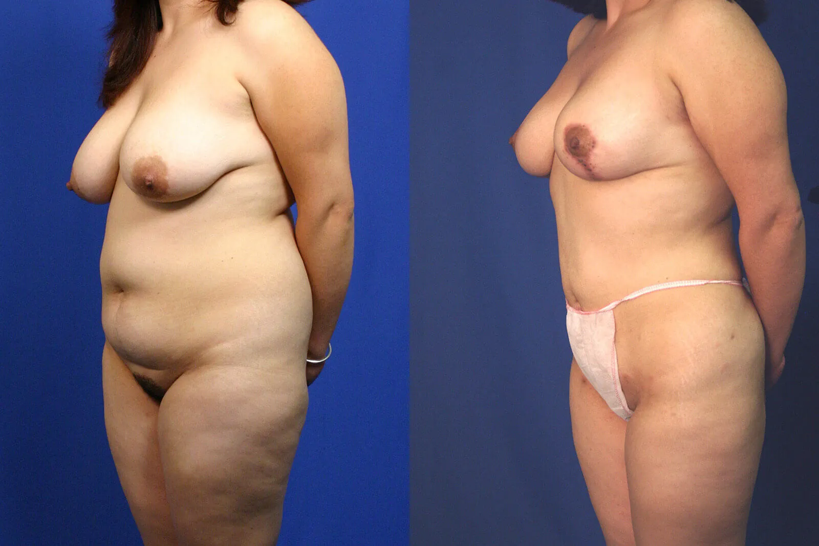 Before and after — Awake Liposuction with FlexSculpt, patient 2