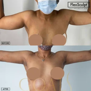 Before and after — Awake Liposuction with FlexSculpt, patient 3