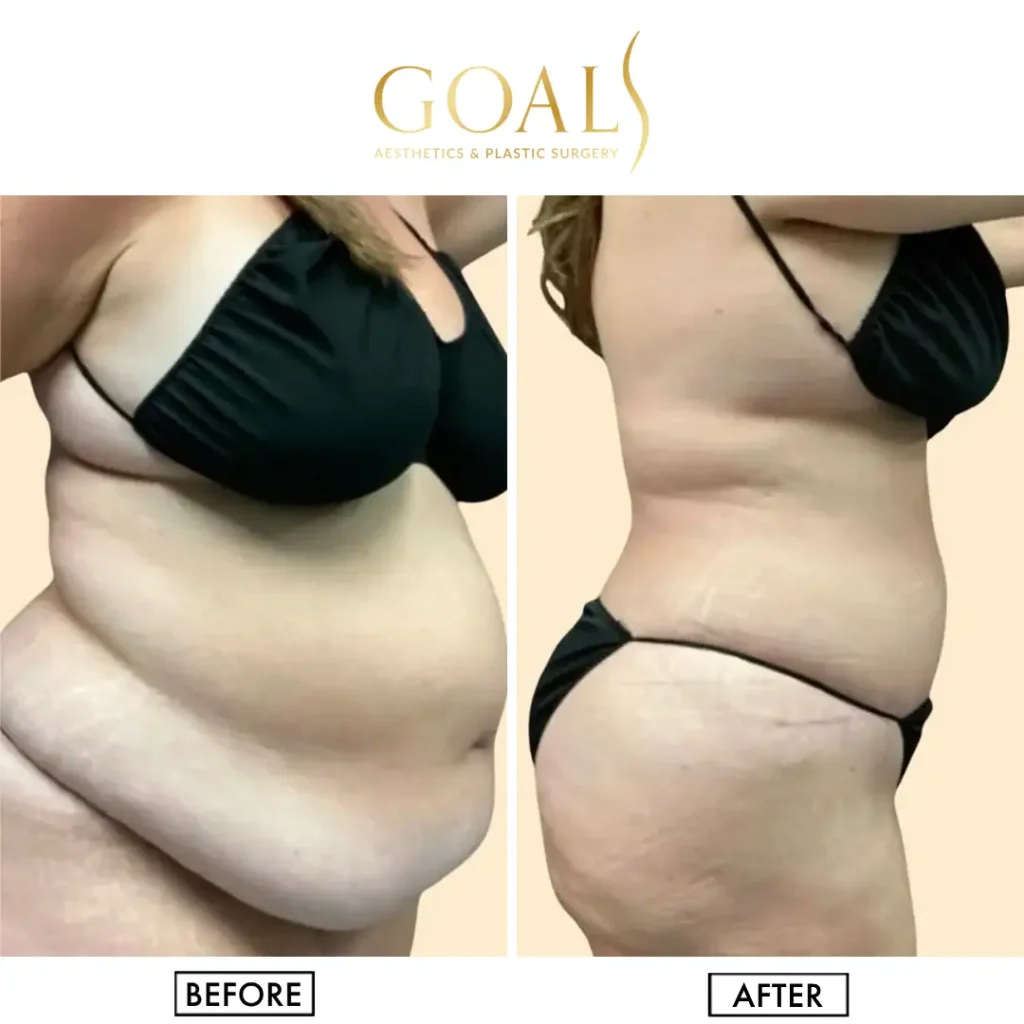 Before and after — Awake Liposuction with FlexSculpt, patient 4
