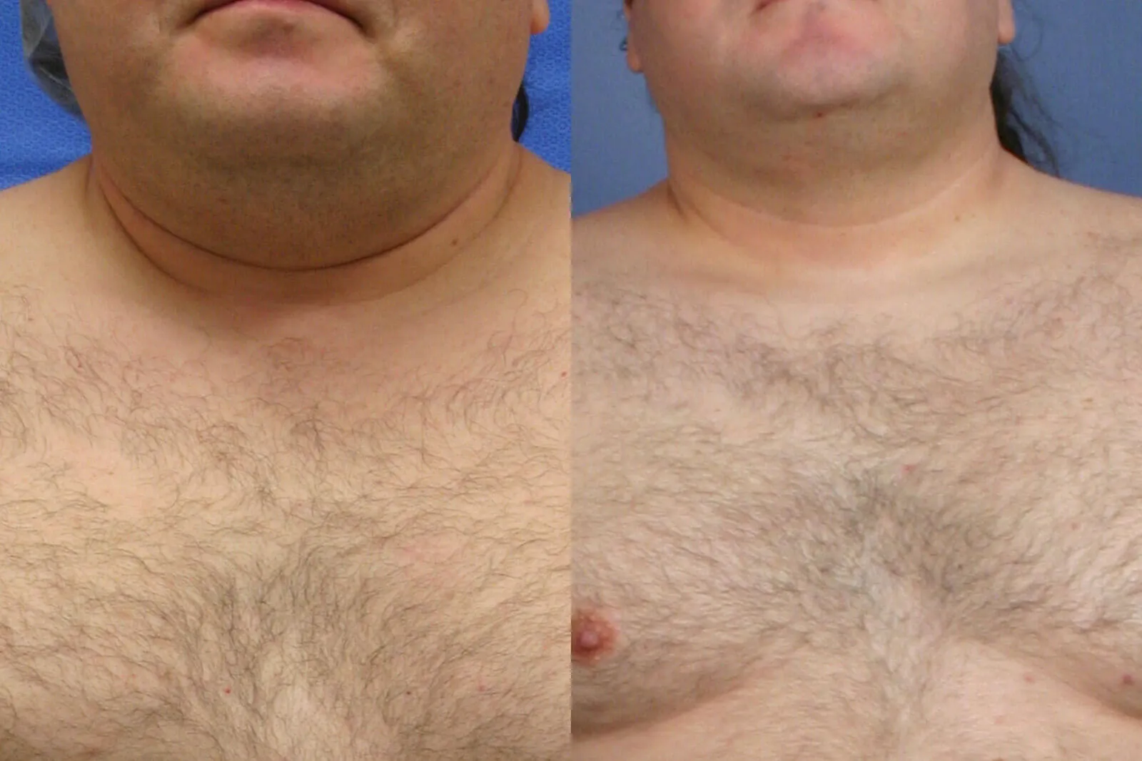 Before and after — Awake Liposuction with FlexSculpt, patient 5