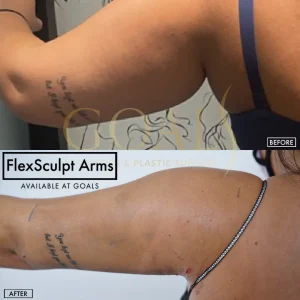 Before and after — Awake Liposuction with FlexSculpt, patient 6