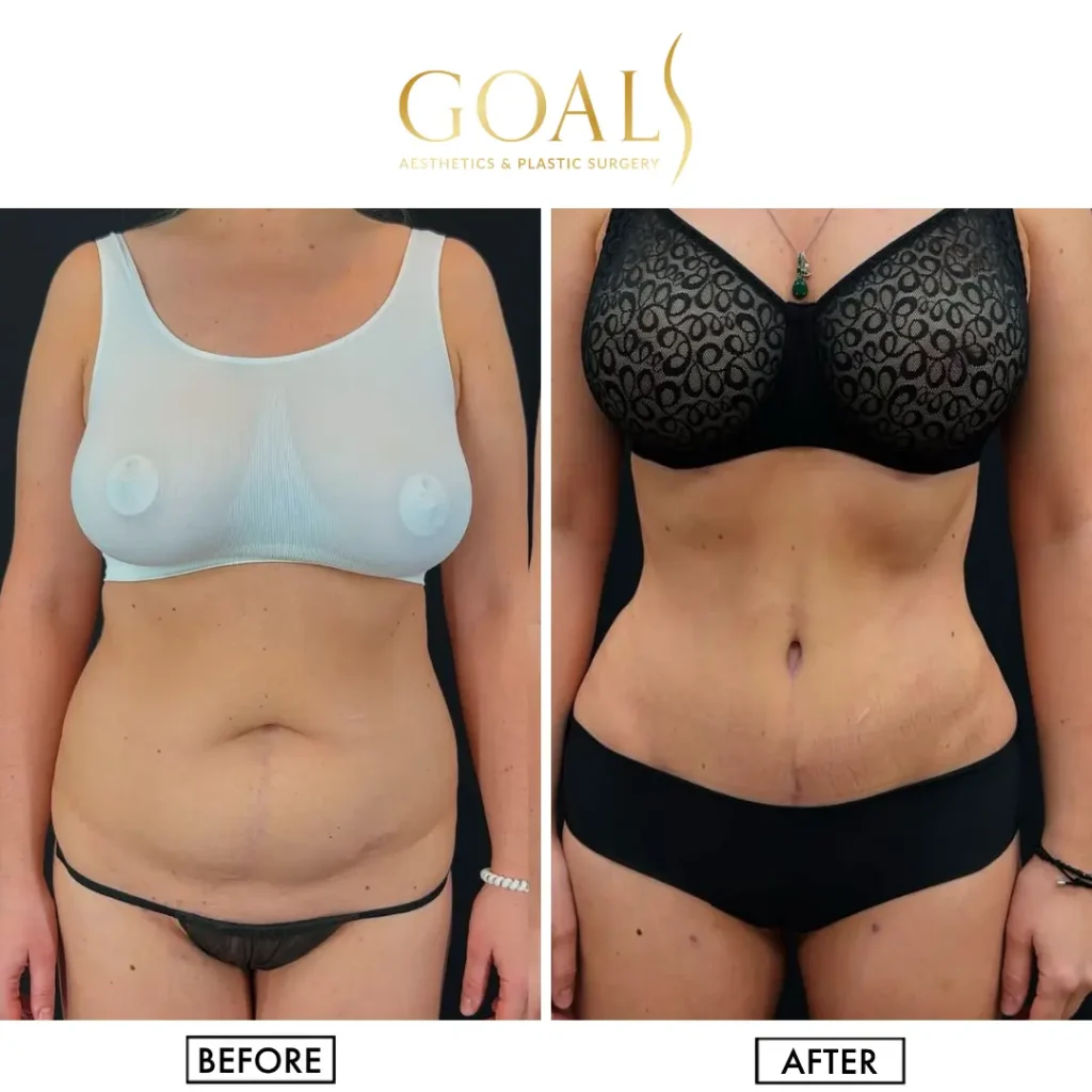 Before and after — Liposuction, patient 5