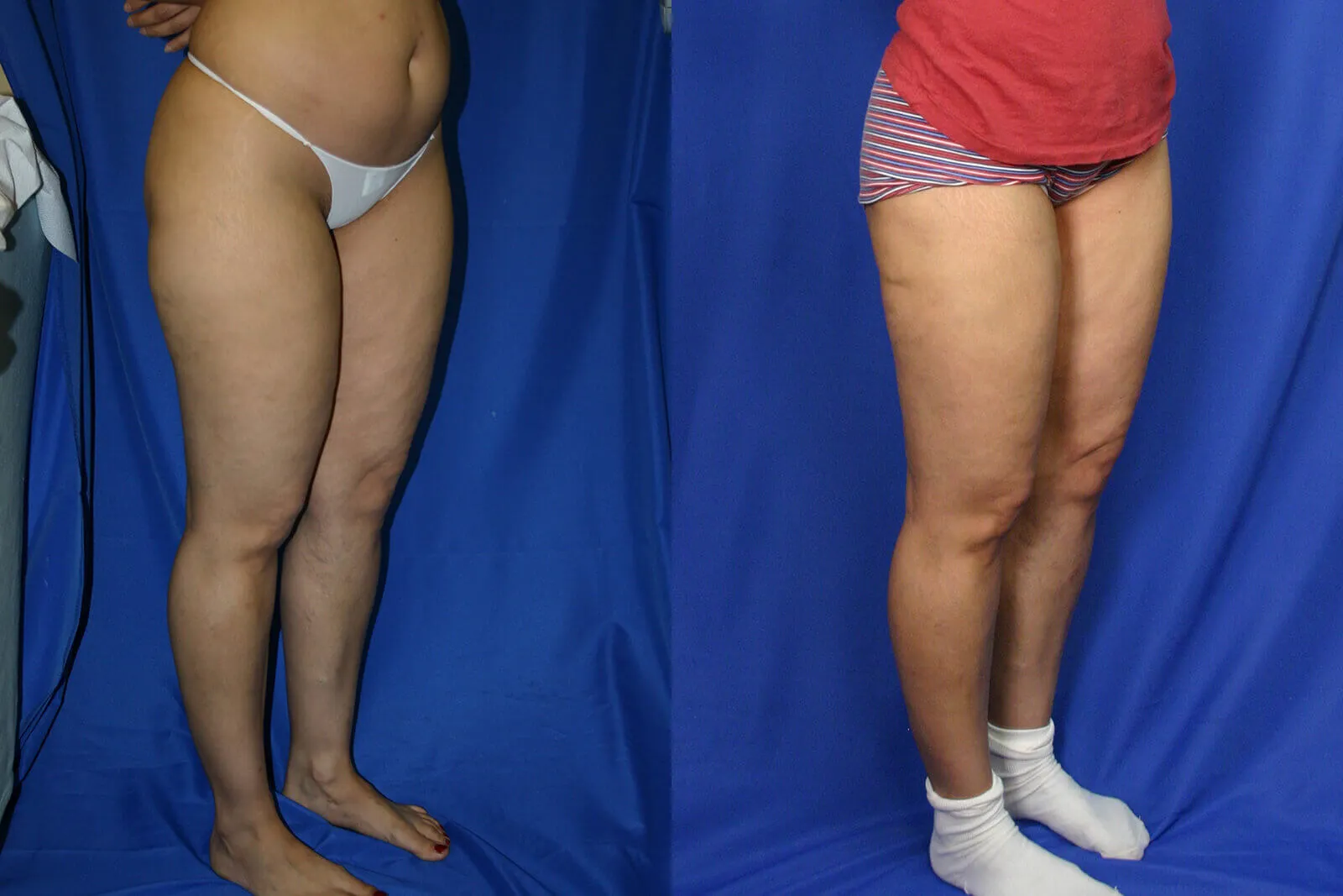 Before and after — Central Park, patient 1