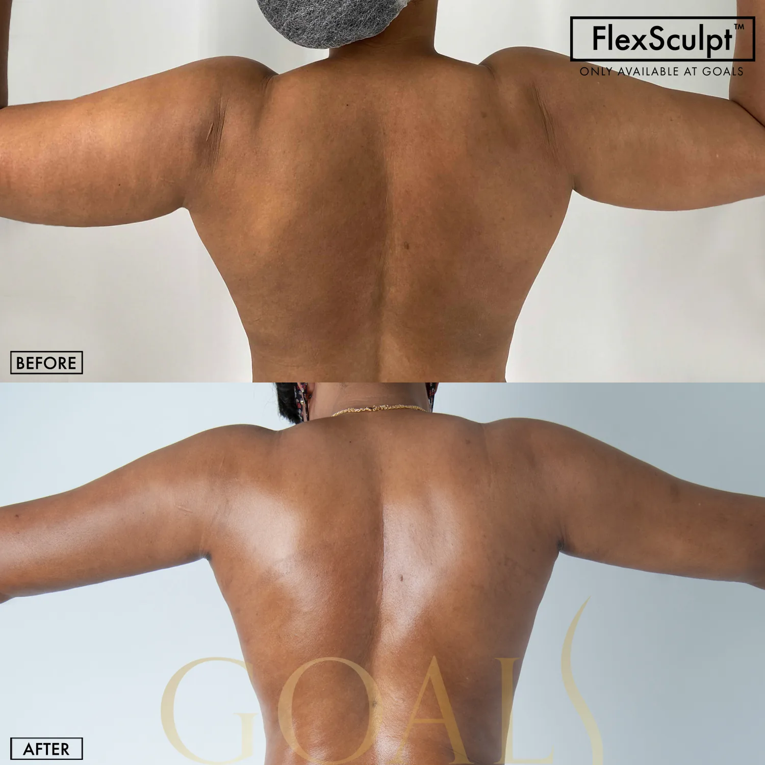 Before and after — Liposuction, patient 6
