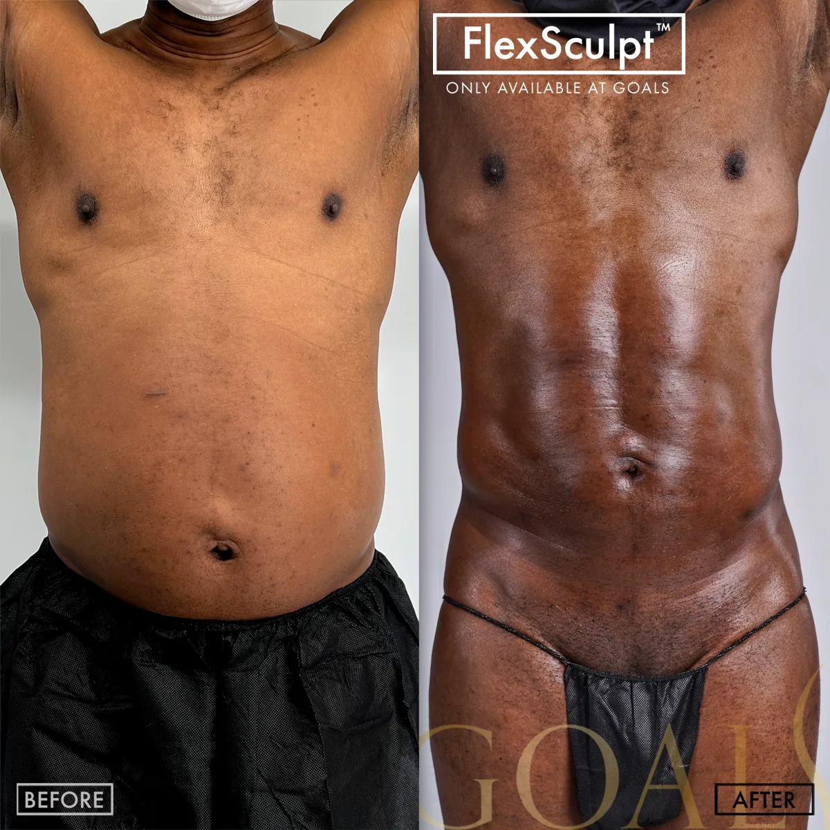 Before and after — Liposuction, patient 3