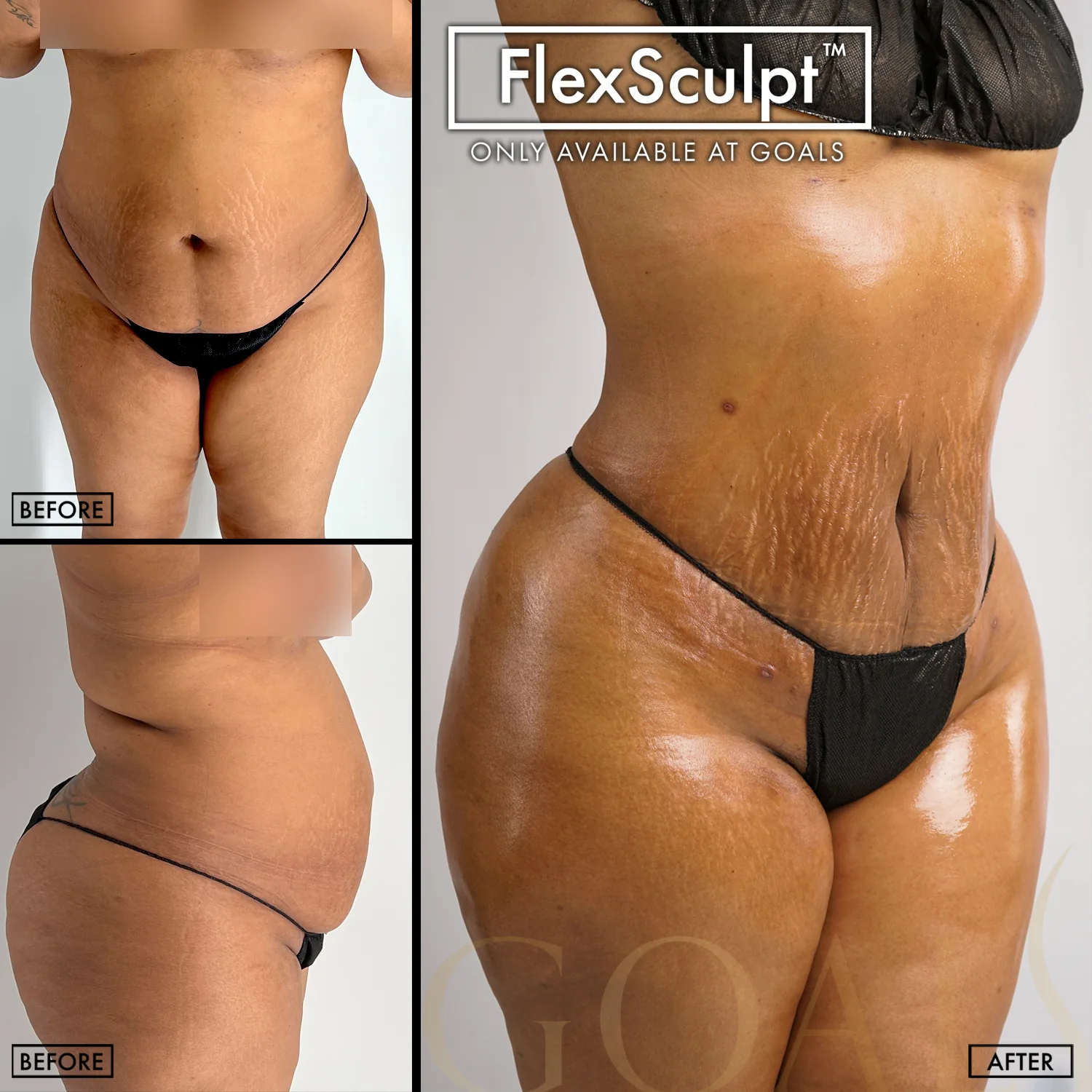 Before and after — Liposuction, patient 4