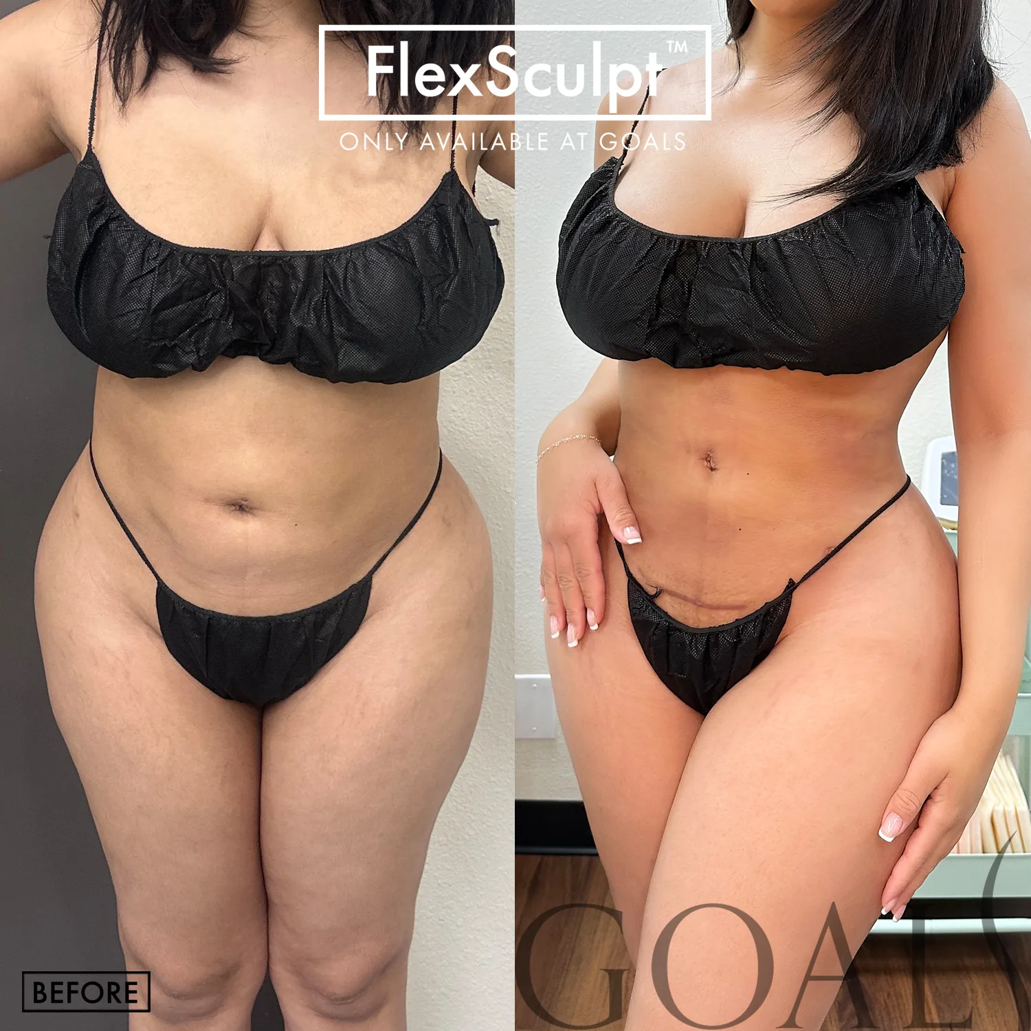 Before and after — Liposuction, patient 1