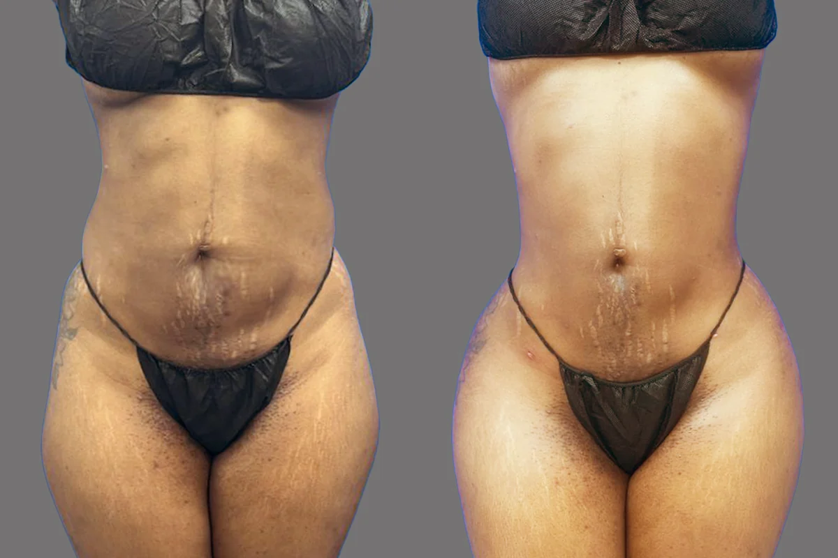 Before and after — J-Plasma Skin Tightening, patient 2