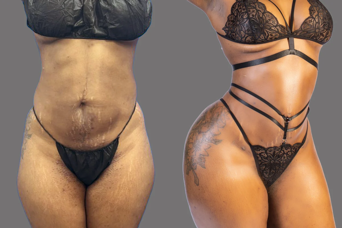 Before and after — J-Plasma Skin Tightening, patient 3