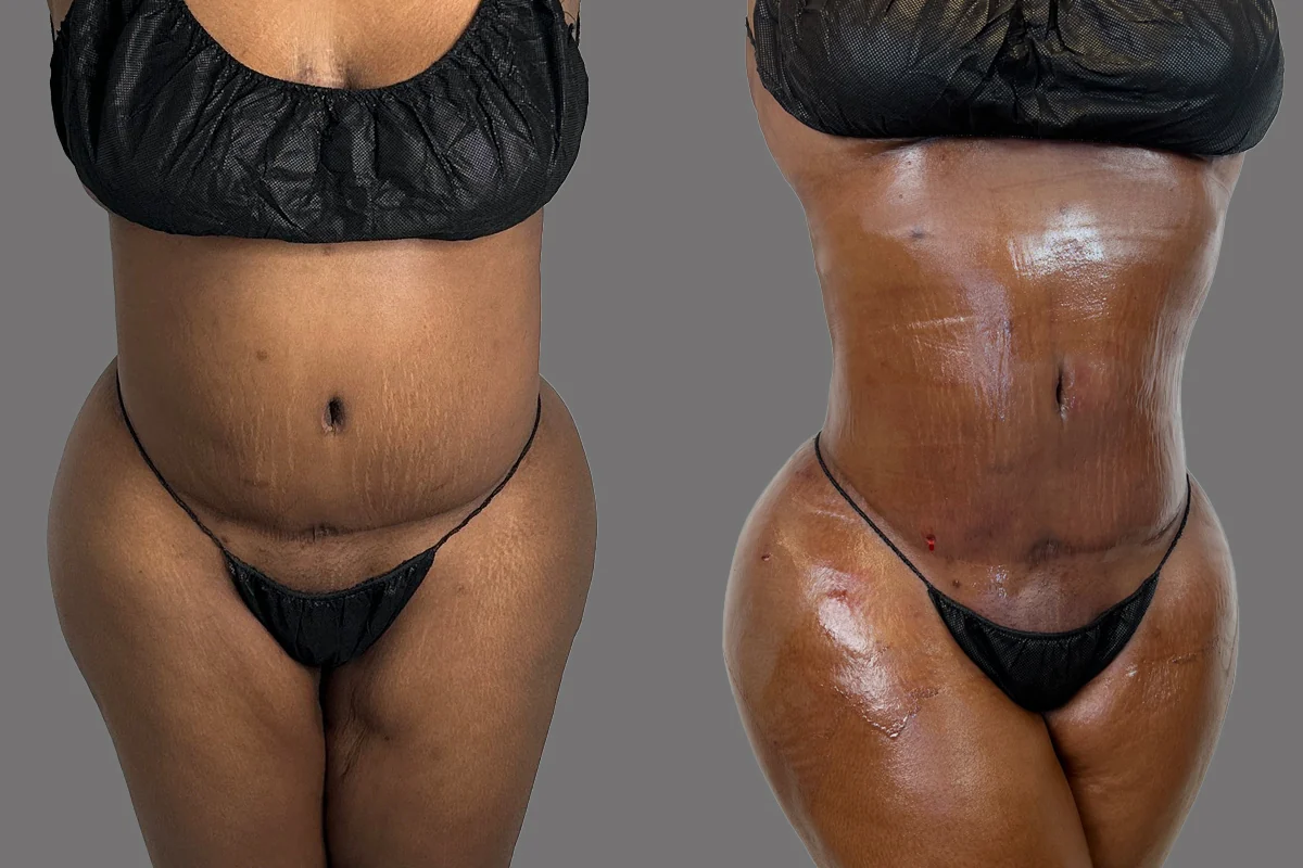 Before and after — J-Plasma Skin Tightening, patient 4