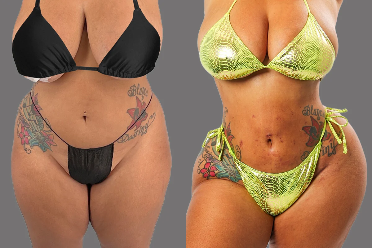 Before and after — J-Plasma Skin Tightening, patient 5