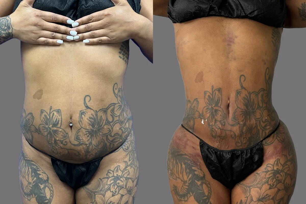 Before and after — J-Plasma Skin Tightening, patient 6