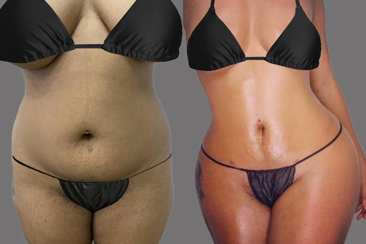 Before and after — J-Plasma Skin Tightening, patient 1